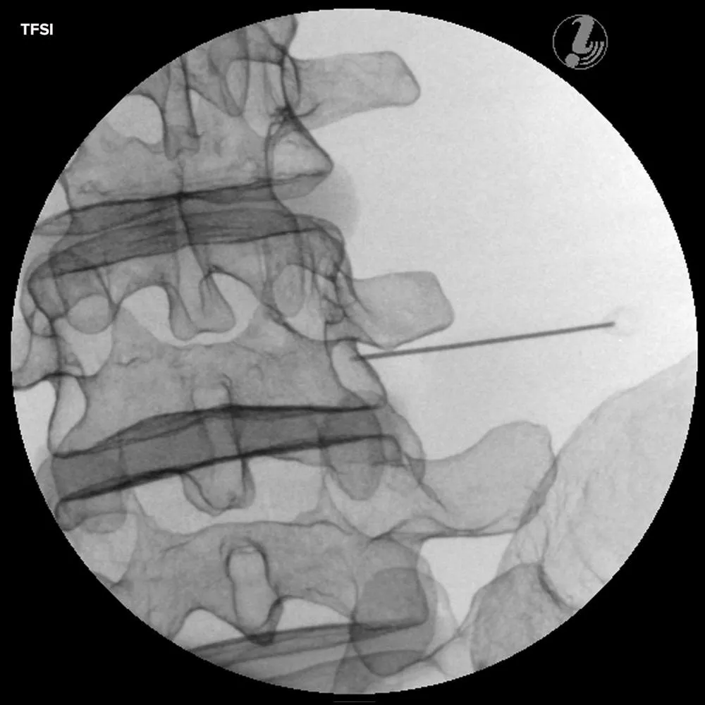 Image Guided Lumbar Spinal Injection Trainer